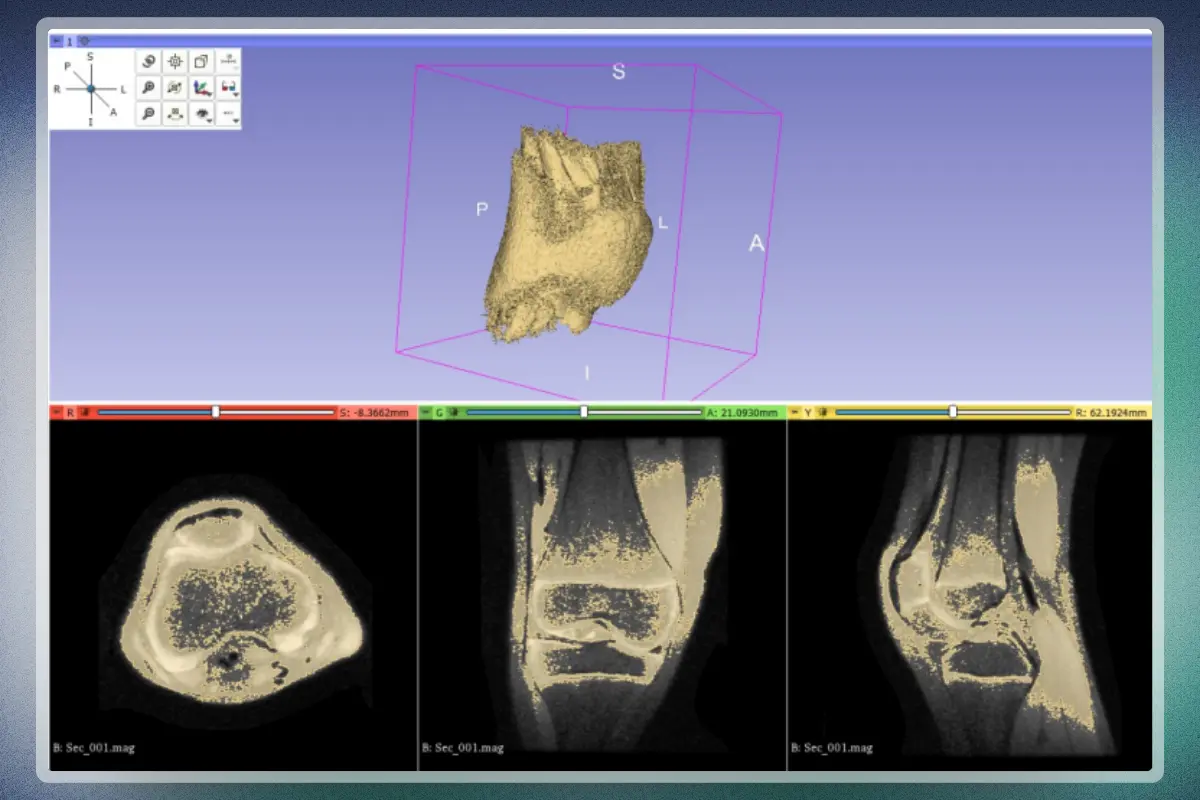 Adaptación de prótesis para rodilla